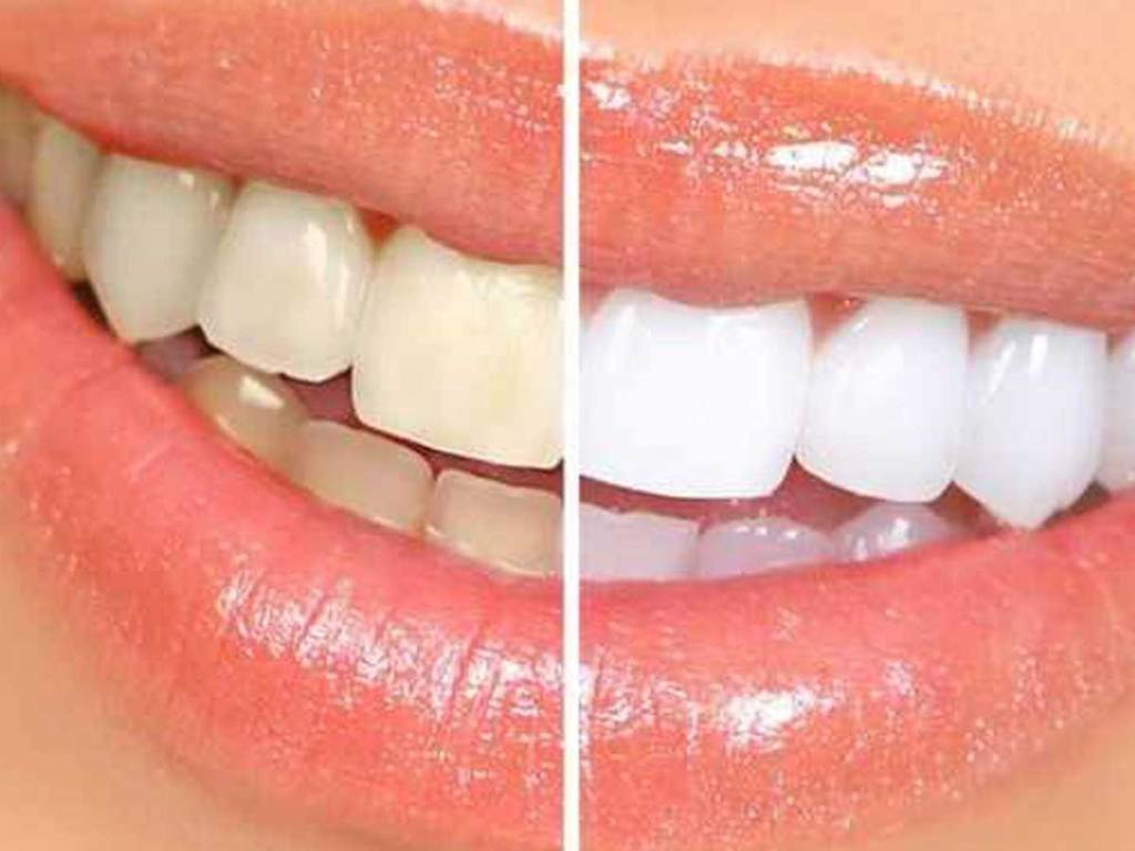 teeth before and after of whitening strips