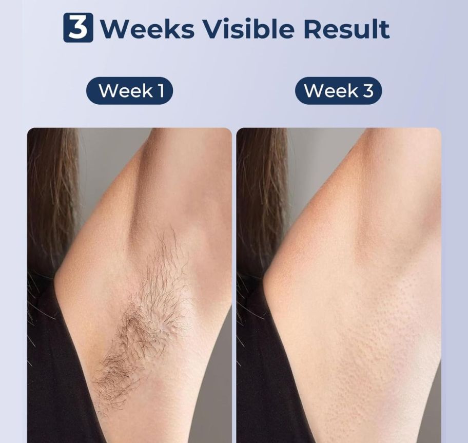 lubex ipl hair growth onlineparison at weeks 1 and 3