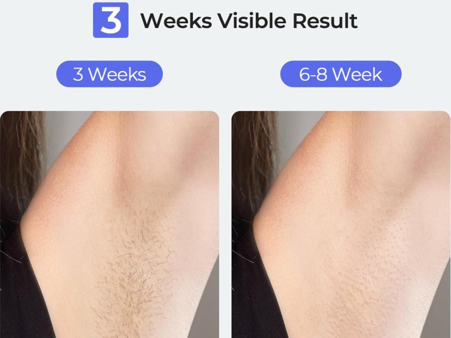 under arm results from laser hair removal